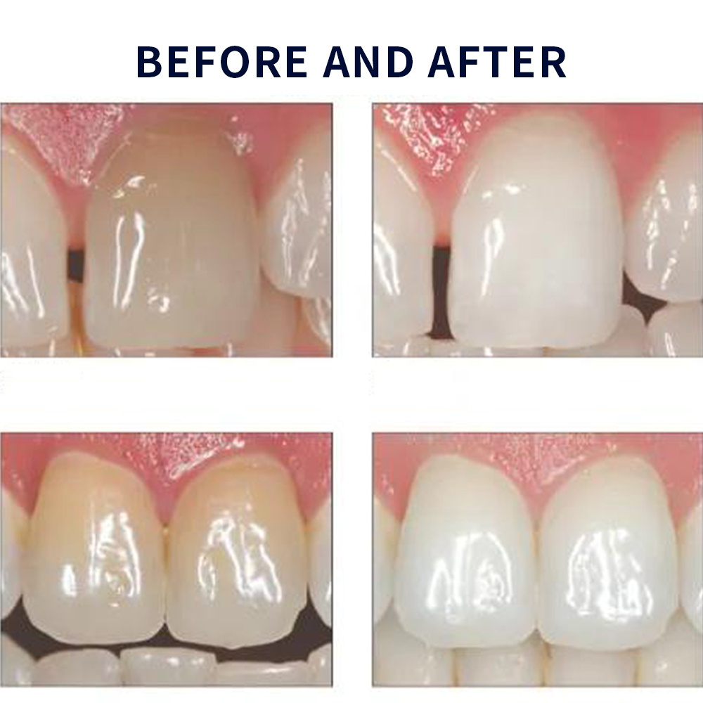 Opalescence Whitening 20% PF 2 - Teeth Whitening Hydrogen Peroxide review and price