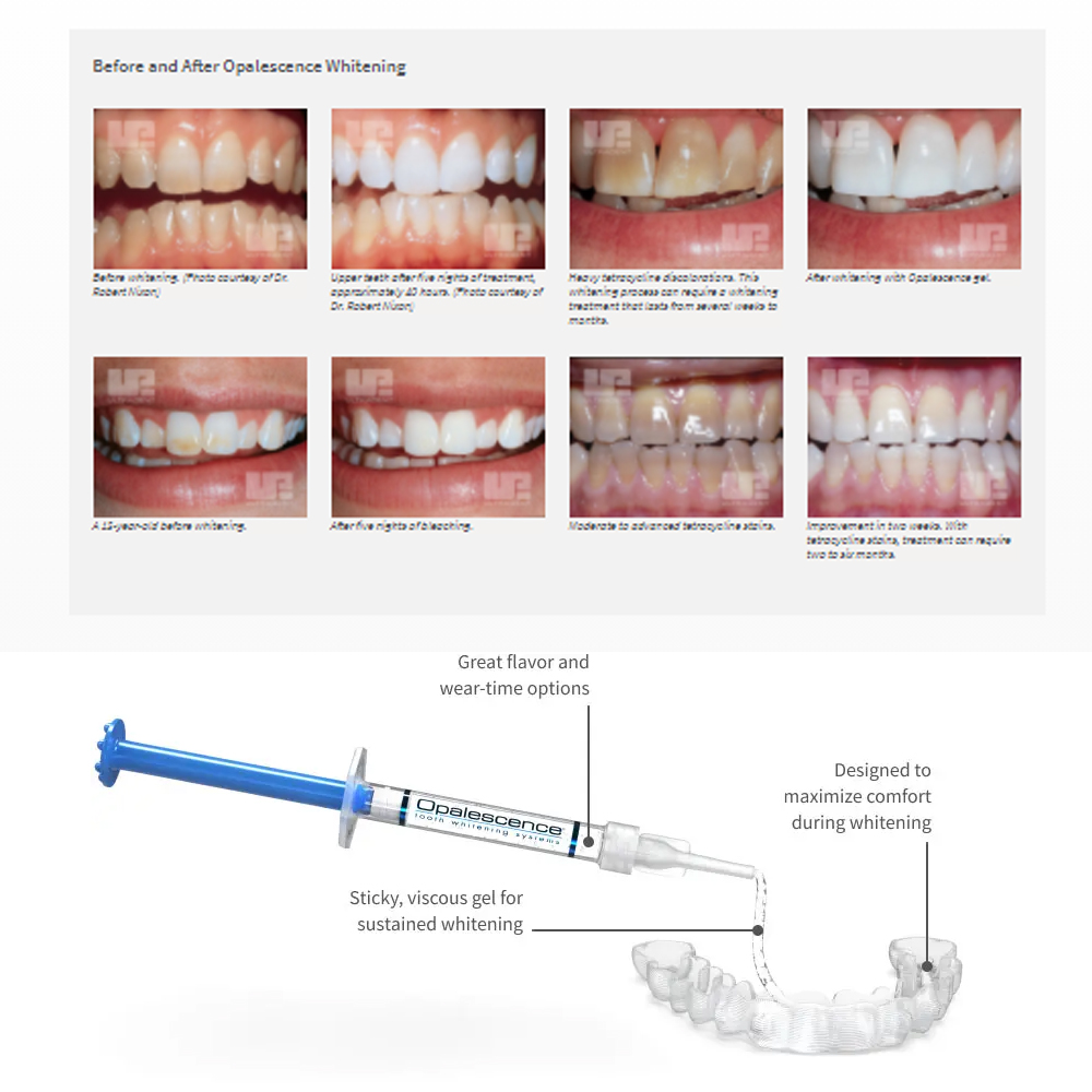Opalescence Whitening 20% PF 2 - Teeth Whitening Hydrogen Peroxide review and price