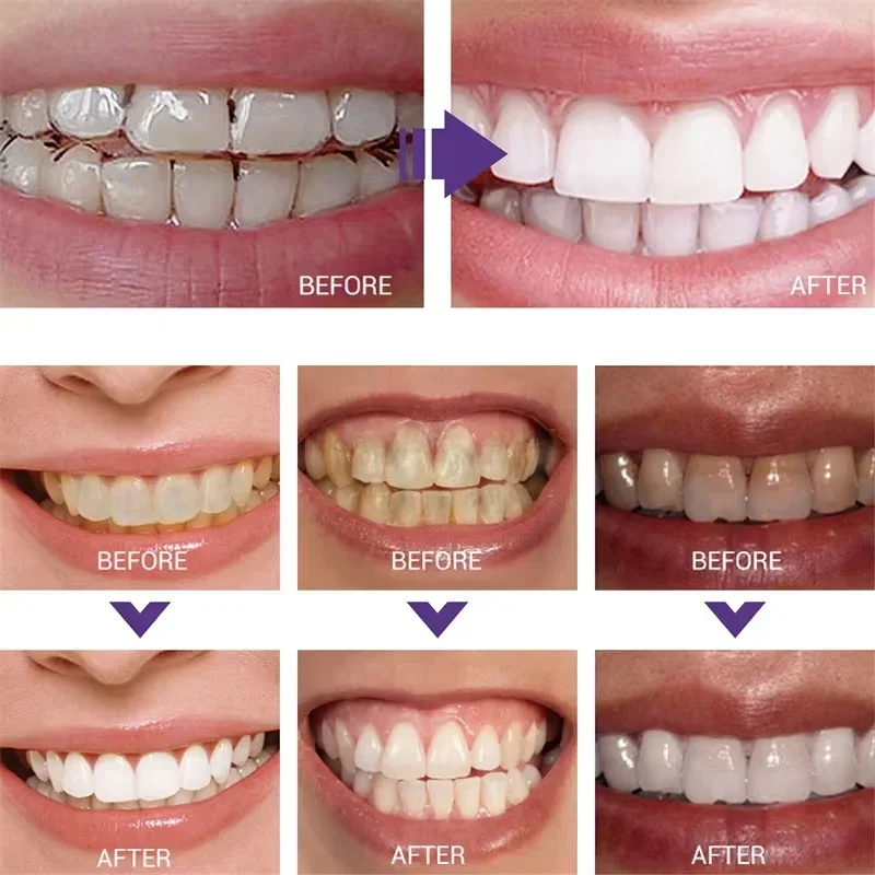 Teeth Cleansing Whitening Toot - Teeth Whitening In Korea review and price